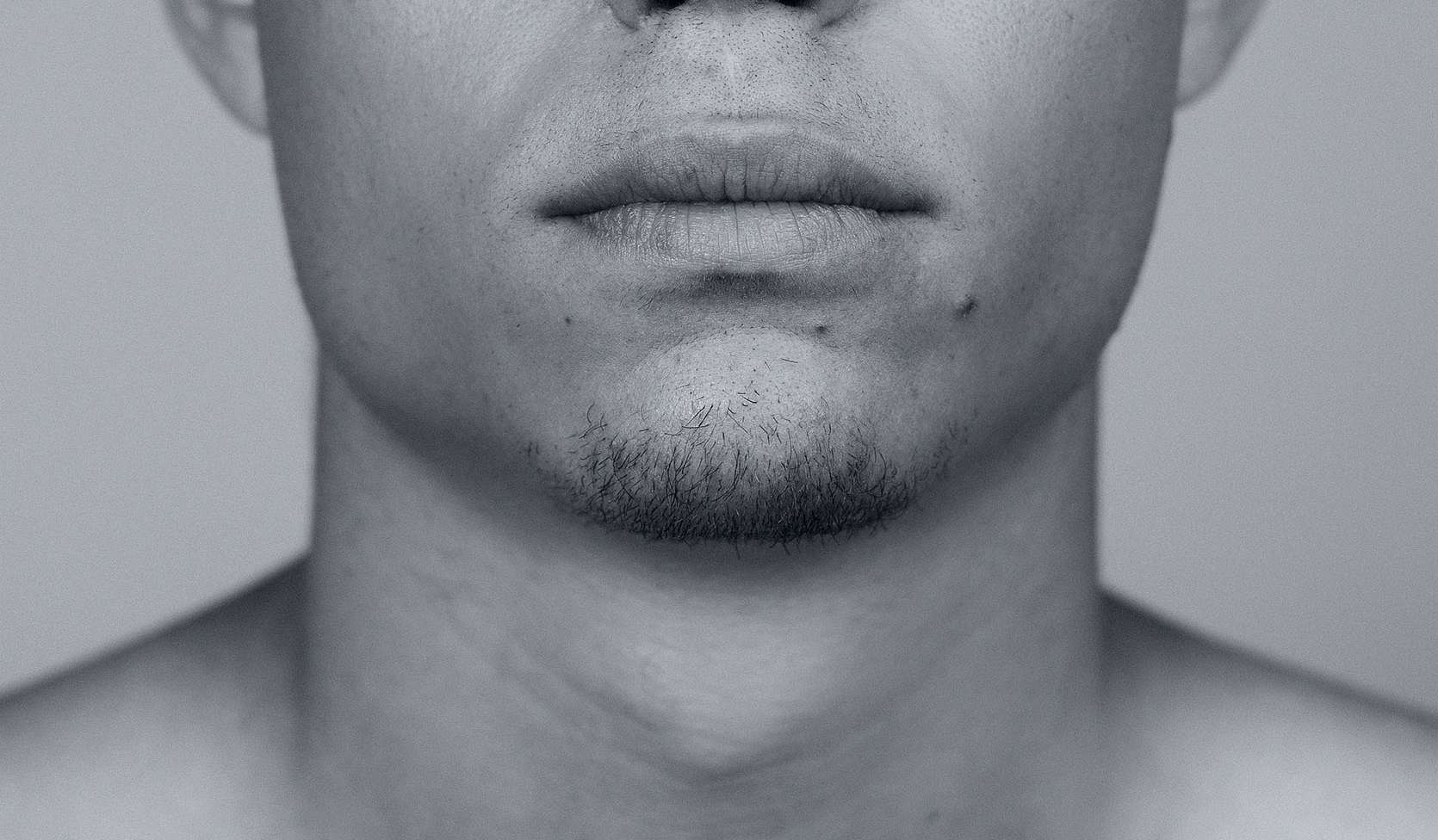 Beard transplant - Face2Face Clinic | Helping trans women transition successfully