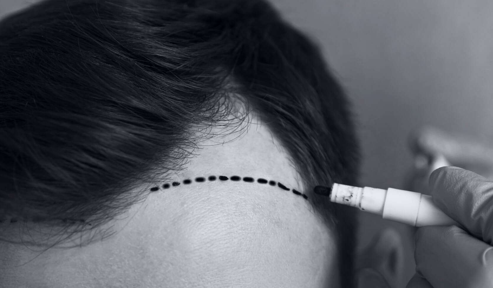 Herstel en nazorg - Face2Face Clinic | Wij helpen transvrouwen bij een succesvolle transitie