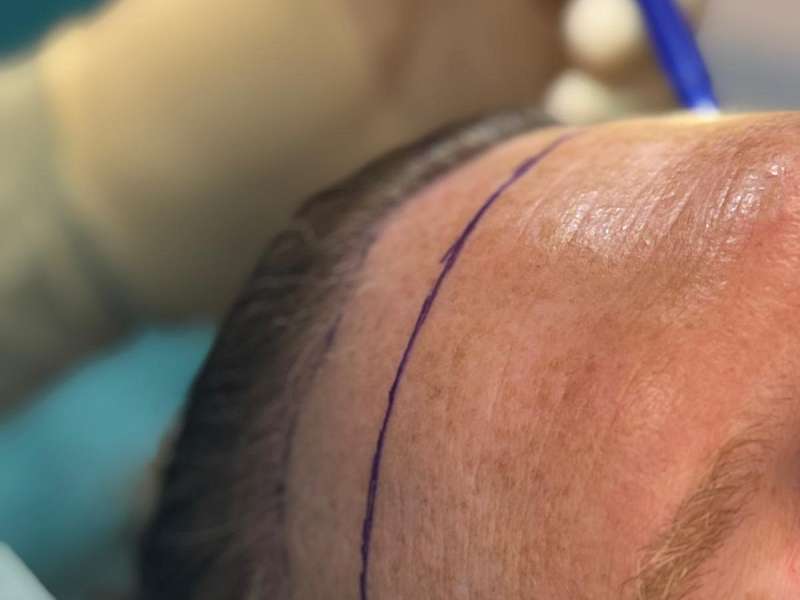 Hairline lowering techniques