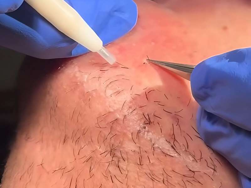 Electrolysis vs Laser